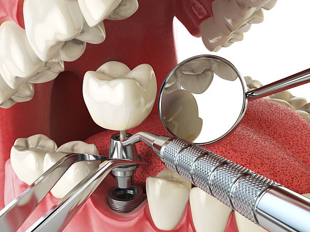 Best Lost Filling or Crown Replacement in Governors Clu, NC